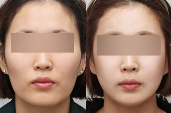 深圳自体脂肪移植