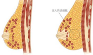 自体脂肪移植多少钱