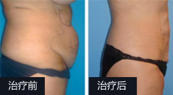 腹部溶脂