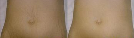 深圳怎么来更好的理解妊娠纹呢?