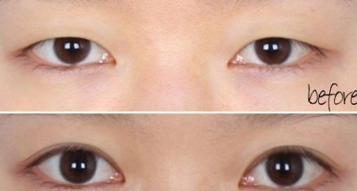 深圳开眼角性如何