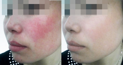 深圳怎样去掉脸上的红血丝?