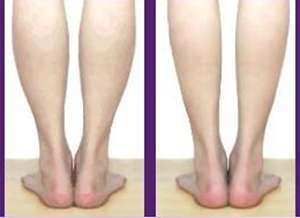 深圳做小腿吸脂术多少钱?