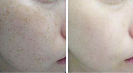 深圳做激光祛斑会不会很疼