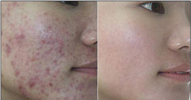 深圳微针去痘坑效果怎么样?