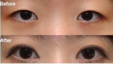 深圳整形做双眼皮的价格?