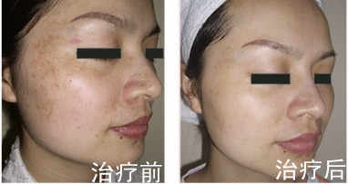 深圳褐青斑如何护理?