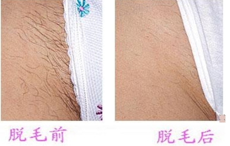 深圳比基尼脱毛选哪种方法好?