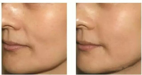 深圳水光针注射的特点有哪些?