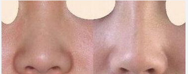 深圳假体隆鼻哪里好