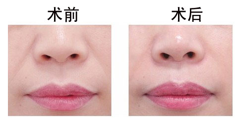 深圳漂唇后多久恢复?