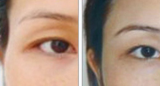 深圳丰太阳穴的价格贵吗?