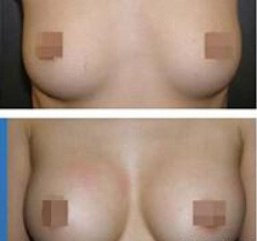 深圳乳晕缩小有哪些方法?