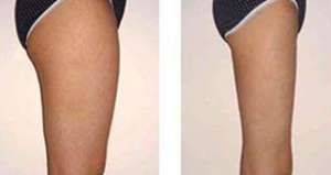 深圳大腿吸脂后的护理工作?