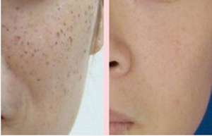 深圳哪家医院可以祛除黄褐斑?