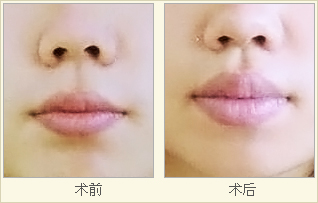 深圳胶原蛋白效果维持时间?