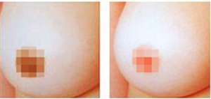 深圳乳晕变黑了怎么办好?