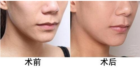 深圳自体脂肪丰面颊哪里好?