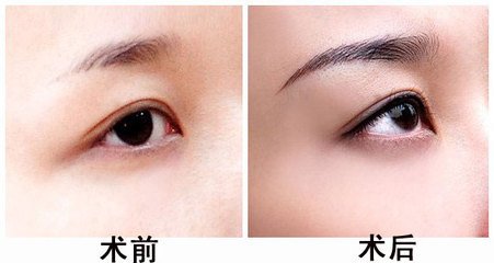 深圳玻尿酸丰眉弓怎么样?