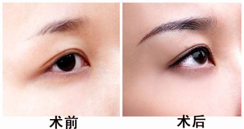 深圳隆眉弓吗?