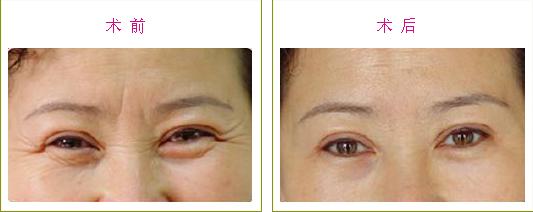 深圳鱼尾纹怎么形成的?