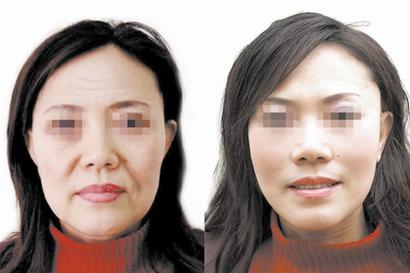 深圳激光去抬头纹好?