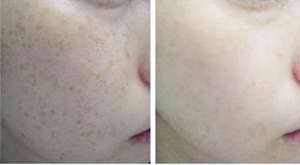 深圳打美白针贵吗