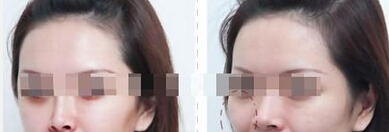 深圳丰苹果肌多少钱?