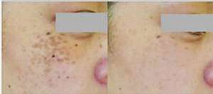 深圳哪里有治斑医院 ?