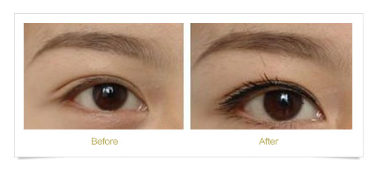 深圳激光洗眼线的优势?