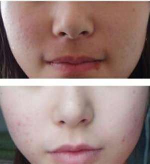 深圳激光去痘印哪家整形医院较好?